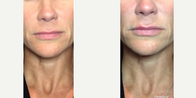 Lip Fillers before and after photo