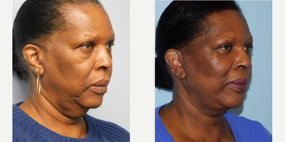 Mini Facelift before and after photo