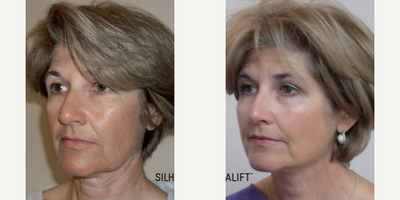 Nonsurgical Facelift before and after photo