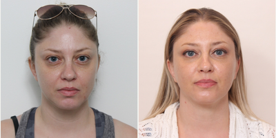Botox before and after photo