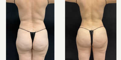 Brazilian Butt Lift before and after photo