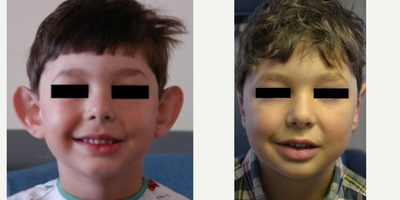 Ear Surgery before and after photo