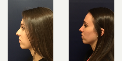 Rhinoplasty before and after photo