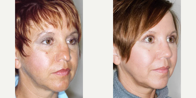 Septoplasty before and after photo