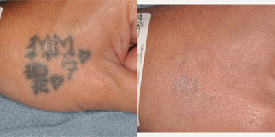 Tattoo Removal before and after photo