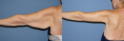 Arm Lift before and after photo