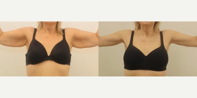 Arm Lift before and after photo