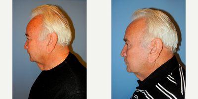 Facelift before and after photo