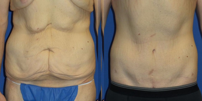 Tummy Tuck before and after photo