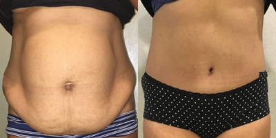 Tummy Tuck before and after photo