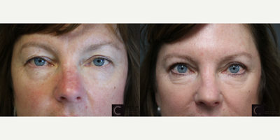 Chemical Peel before and after photo