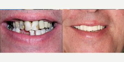 Dental Implants before and after photo
