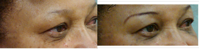 Eyelid Surgery before and after photo
