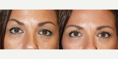 Eyelid Surgery before and after photo
