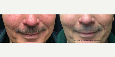 IPL before and after photo