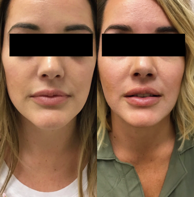 Restylane before and after photo