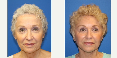 Facelift before and after photo