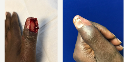 Mohs Surgery before and after photo