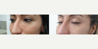Restylane before and after photo
