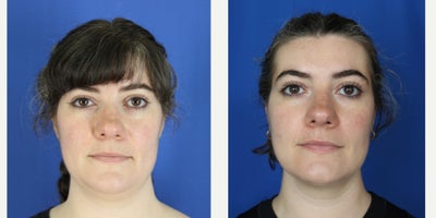 Chin Liposuction before and after photo