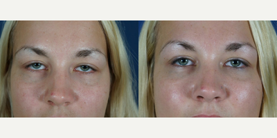 Dermal Fillers before and after photo