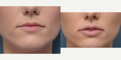 Lip Fillers before and after photo