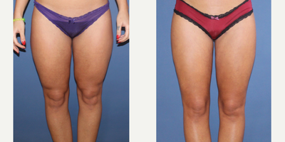 Liposuction before and after photo