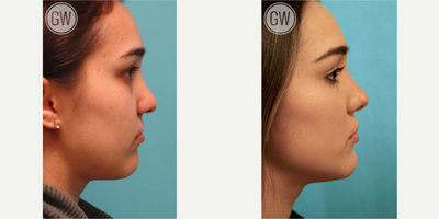 Revision Rhinoplasty before and after photo