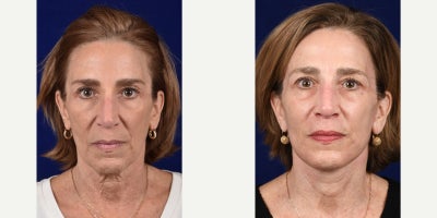 before and after image
