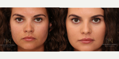 Lip Fillers before and after photo