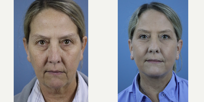 Lower Facelift before and after photo
