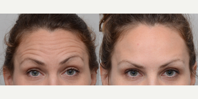 Botox before and after photo