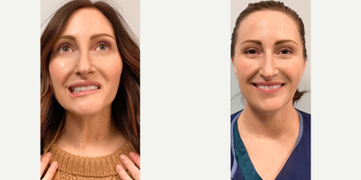Botox before and after photo