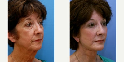 Facial Fat Transfer before and after photo
