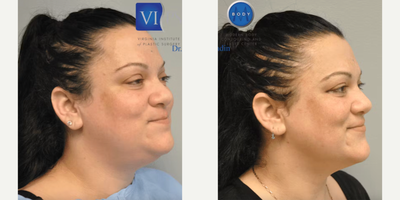 Liposuction before and after photo