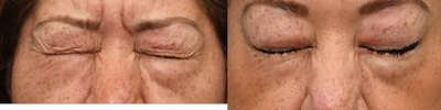 Botox before and after photo