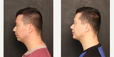 Chin Implant before and after photo