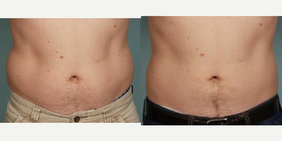 CoolSculpting before and after photo