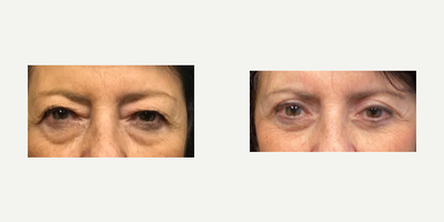 Eyelid Surgery before and after photo