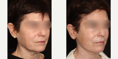 Facelift before and after photo