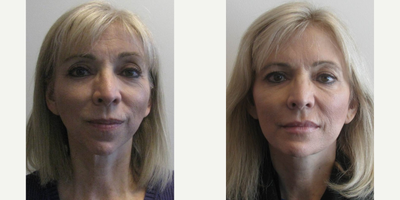 Jaw Surgery before and after photo