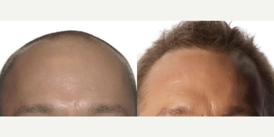 ARTAS Robotic Hair Transplant before and after photo