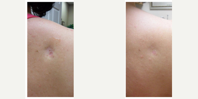 Microneedling before and after photo