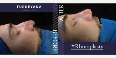 Rhinoplasty before and after photo