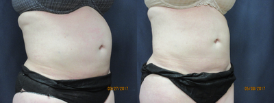 SculpSure before and after photo