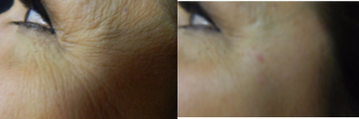 Volbella before and after photo