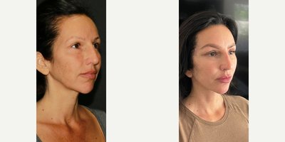 Brow Lift before and after photo