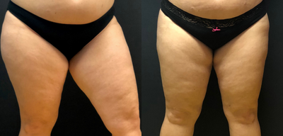 Laser Liposuction before and after photo