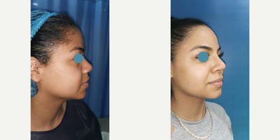 Rhinoplasty before and after photo