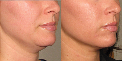 Ultherapy before and after photo